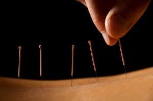 Preston Chiropractic and Acupuncture benefits of acupuncture