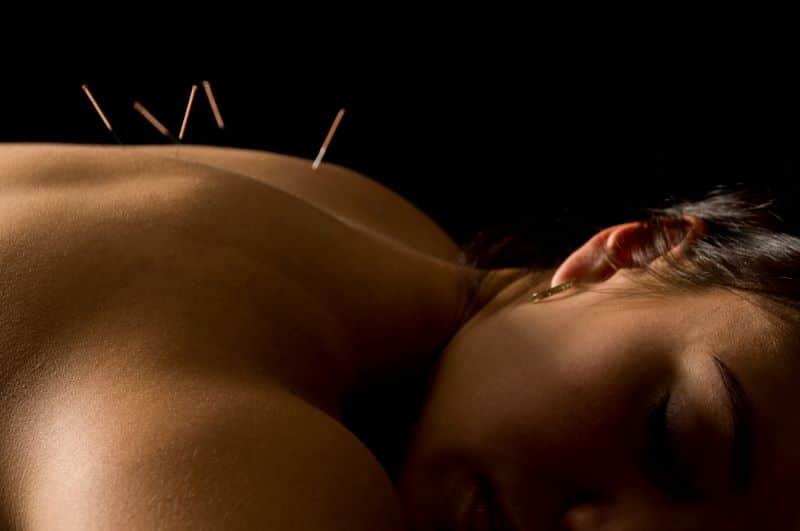 Preston Chiropractic and Acupuncture acupuncture treatment